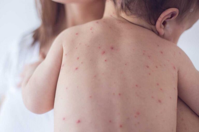 Desde el Ministerio de Desarrollo Humano hablaron de la varicela