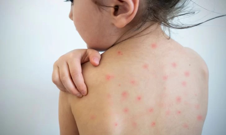 Un caso de sarampión en Entre Ríos reactivó la alerta sanitaria nacional: los detalles del paciente y cómo se encuentra