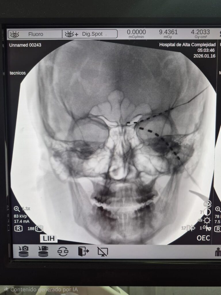 Hito médico en el HAC: primera colocación de un neuroestimulador para dolor crónico craneofacial